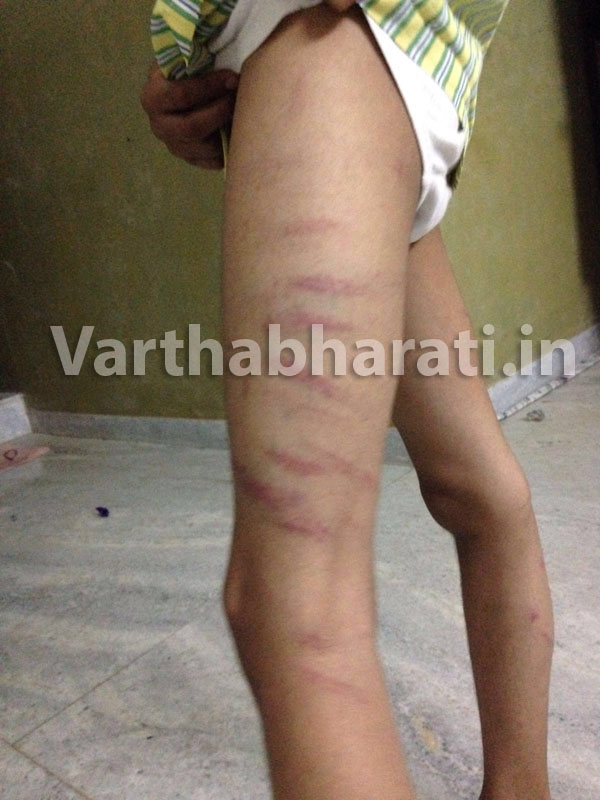 ಉಪ್ಪಳ :ಮದ್ರಸಾ ಅಧ್ಯಾಪಕನಿಂದ ವಿದ್ಯಾರ್ಥಿ ಮೇಲೆ ಥಳಿತ : ವಿದ್ಯಾರ್ಥಿಗೆ ಗಾಯ